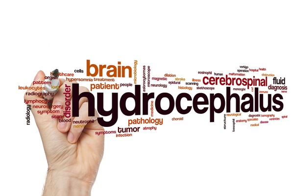 Hydrocephalus Treatment